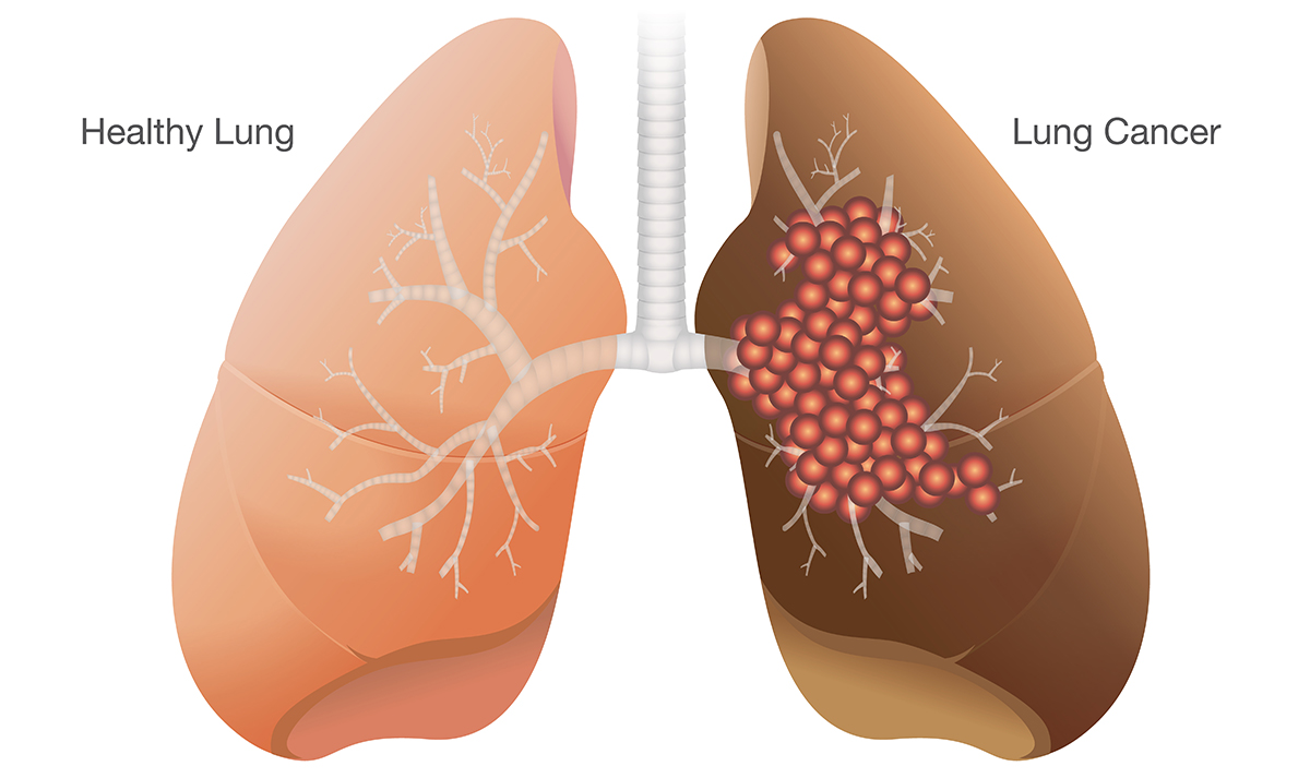 Ung thư phổi là gì?
