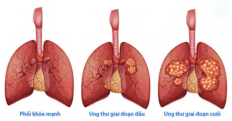 Ho nhiều về đêm có thể là dấu hiệu cảnh báo ung thư phổi