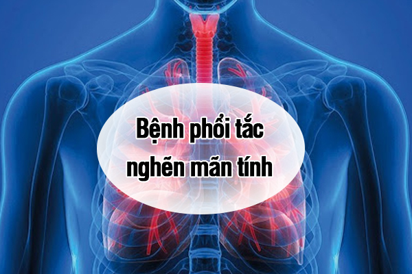 Dấu hiệu nhận biết và cách điều trị bệnh phổi tắc nghẽn mãn tính là gì?