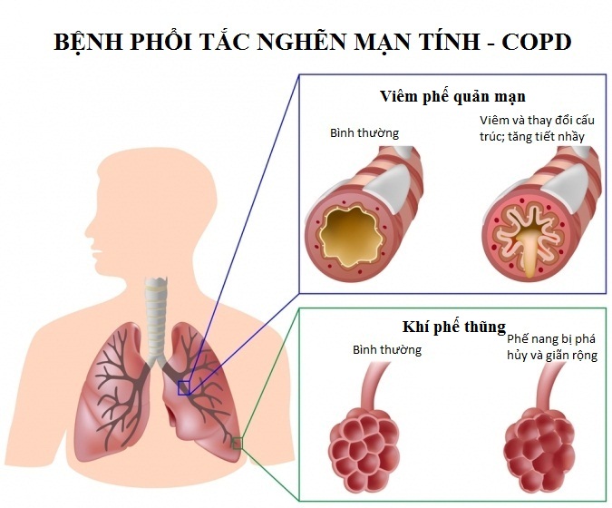 BoniDetox cho hiệu quả vượt trội nhờ cơ chế toàn diện và công nghệ bào chế hiện đại