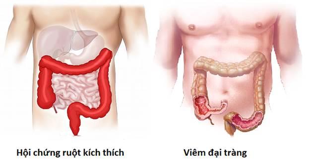 Hội chứng ruột kích thích và viêm đại tràng là 2 bệnh dễ nhầm với nhau