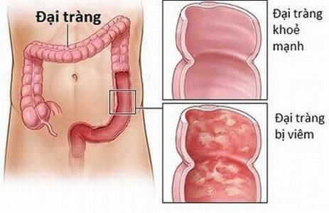 Viêm đại tràng sẽ có những tổn thương trên niêm mạc