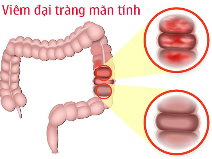 Những sai lầm trong đ_iều trị và chế độ ăn uống mà người bệnh viêm đại tràng mãn tính thường gặp phải