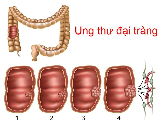 Biến chứng ung thư đại tràng