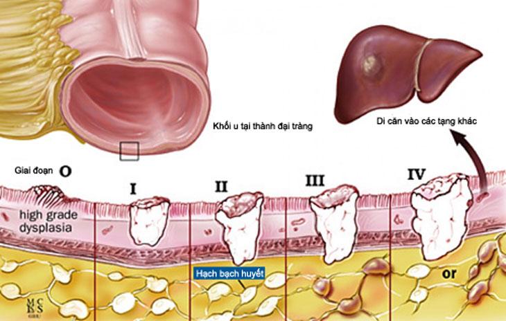 Tế bào ung thư có thể di căn qua hệ bạch huyết.