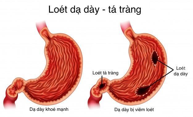 Viêm loét dạ dày có thể gây tình trạng đi ngoài nhiều lần