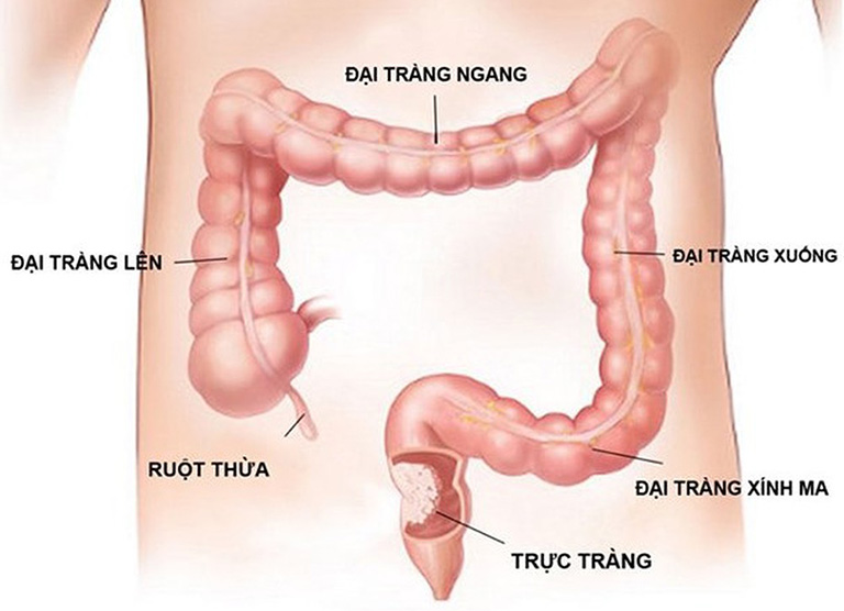 Đ_iều trị viêm đại tràng mạn tính dưới góc độ Đông y