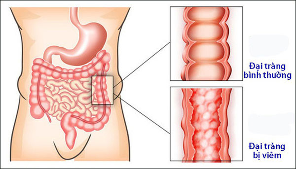 Tổng hợp các nguyên nhân viêm đại tràng và bật mí giải pháp đi-ều trị viêm đại tràng đến từ chuyên gia