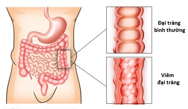 5 Nguyên nhân và 4 triệu chứng điển hình của bệnh viêm đại tràng