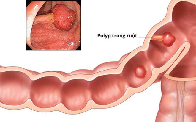 polyp đại tràng