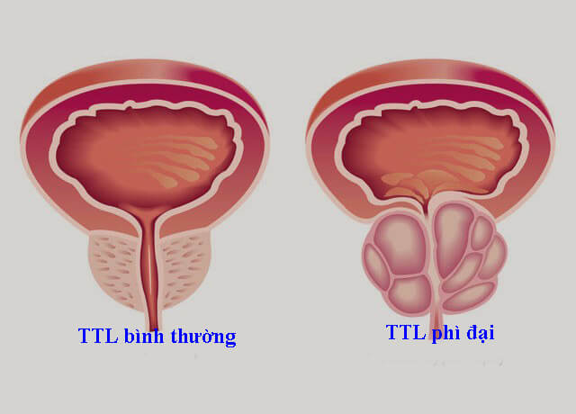 BoniMen phòng và hỗ trợ điều trị chứng tiểu đêm