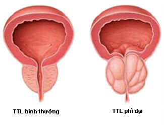 BoniMen trị phì địa tuyến tiền liệt