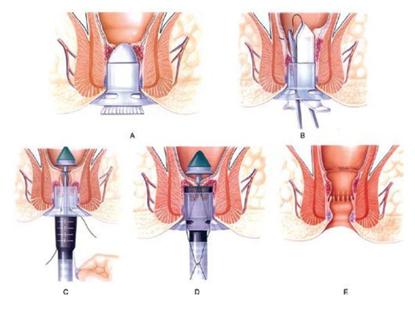 Phương pháp Longo phẫu thuật bệnh trĩ