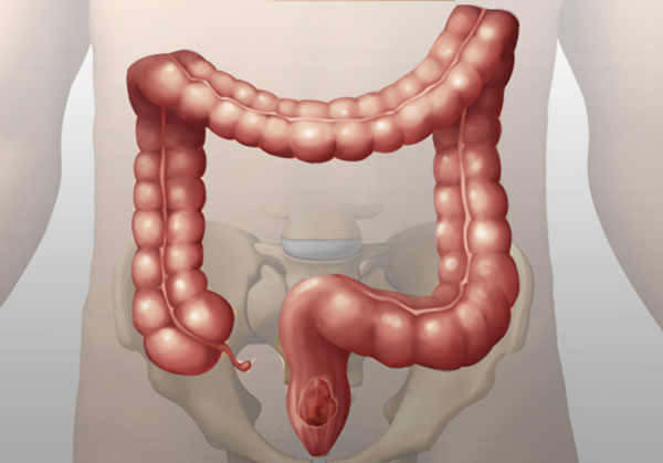 Viêm đại tràng cấp tính: biểu hiện triệu chứng, cách chẩn đoán và đ-iều trị