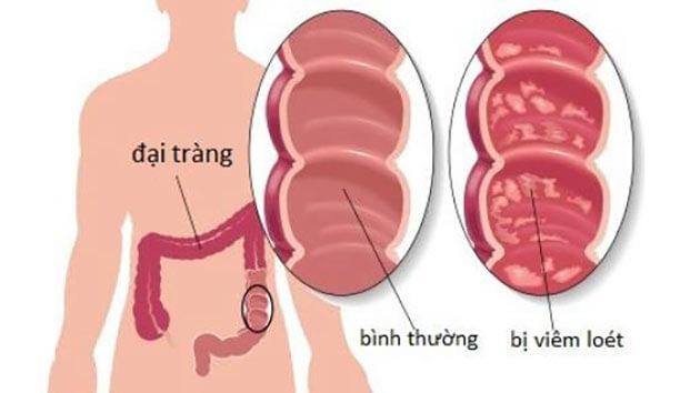 Hỗ trợ điều trị viêm đại tràng bằng lợi khuẩn