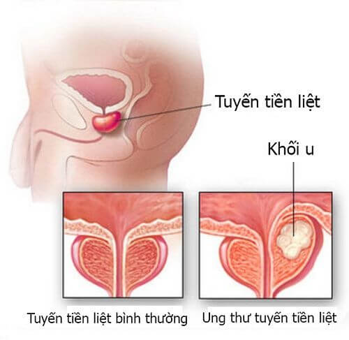 PSA và fPSA - Dấu ấn của  ung thư tuyến tiền liệt