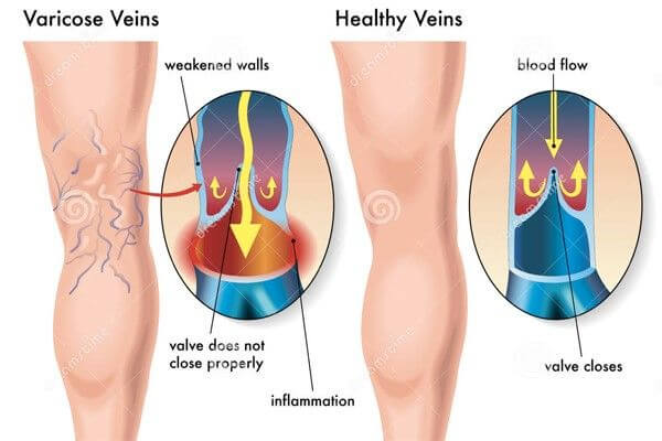 Phân biệt tĩnh mạch sâu và nông