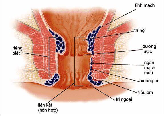 Triệu chứng nhận biết bệnh trĩ nội